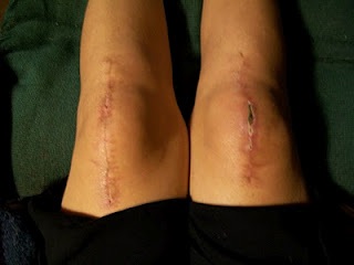 knee replacements